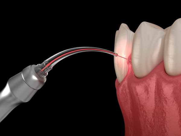 Laser Dentistry